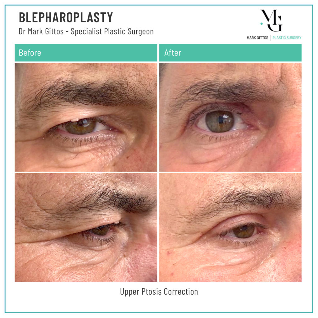 Eyelid Lift Before and After - Upper Ptosis Correction - Dr Mark Gittos Specialist Plastic Surgeon NZ