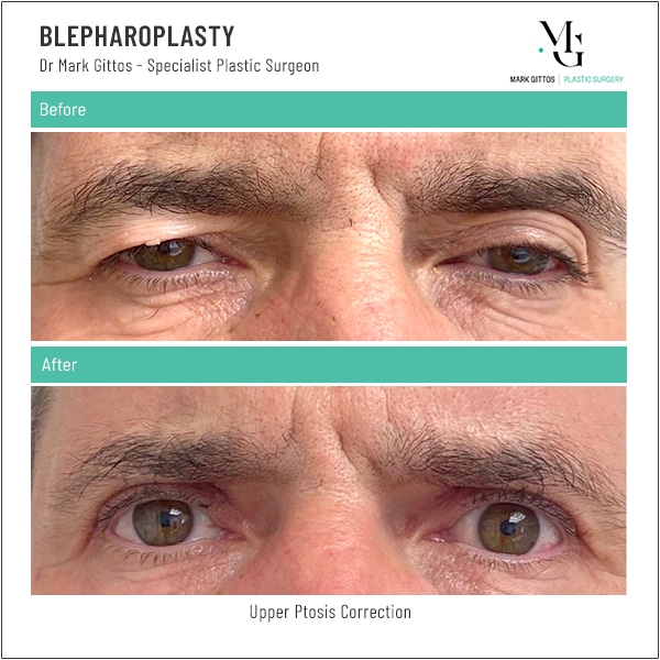Eyelid Lift Before and After - Upper Ptosis Correction - Dr Mark Gittos Specialist Plastic Surgeon NZ