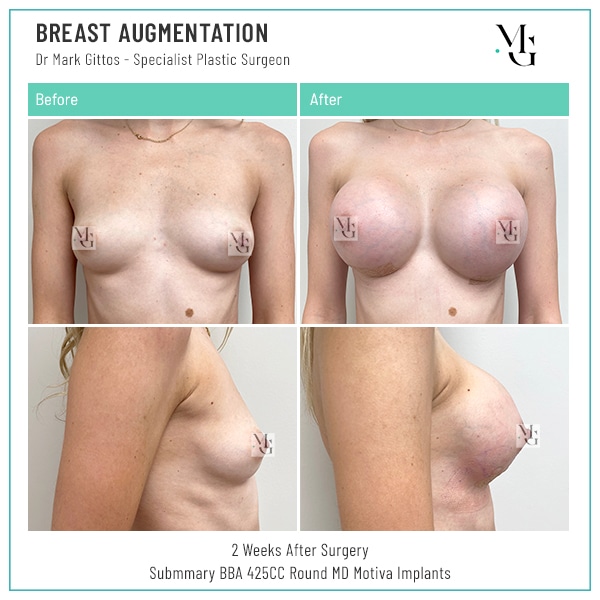 Submammary BBA 425cc Round MD Motiva Implants