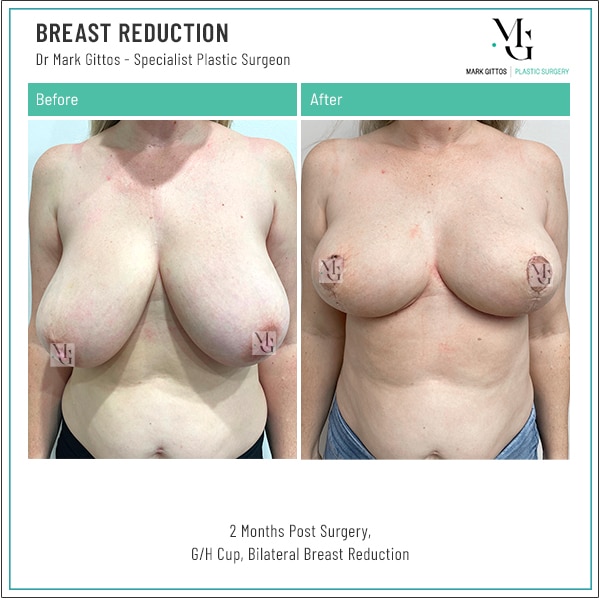 Breast reduction Before and After Photos -Dr Mark Gittos
