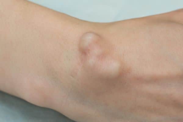 ganglion cyst wrist - lump on hand - Dr Mark Gittos Best Plastic Surgeon NZ