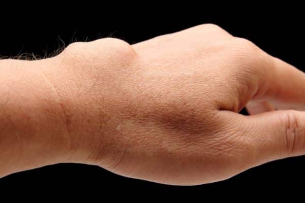 ganglion cyst wrist - lump on hand - Dr Mark Gittos Best Plastic Surgeon NZ