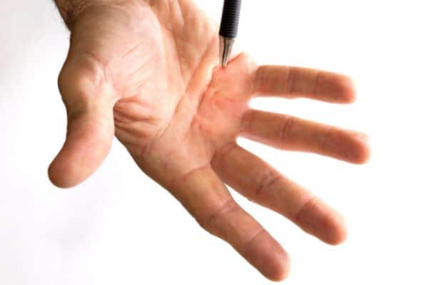 Diagnose Dupuytren Disease New Zealand - Dupuytren's Contracture Auckland - Dr Mark Gittos Best Plastic Surgeon NZ