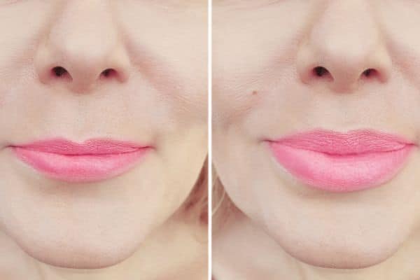 Lip Lift NZ - lip augmentation auckland - Dr Mark Gittos Best Plastic Surgeon New Zealand