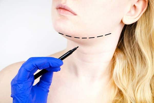 double chin removal NZ - Chin reduction surgery recovery - Turkey Neck Lift Procedure Auckland - Dr Mark Gittos Best Plastic Surgeon NZ