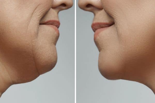 double chin removal NZ - Chin reduction surgery recovery - Dr Mark Gittos Best Plastic Surgeon NZ