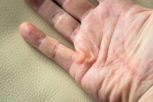 Treatment for Dupuytren Disease New Zealand - Dupuytren's Contracture Auckland - Dr Mark Gittos Best Plastic Surgeon NZ