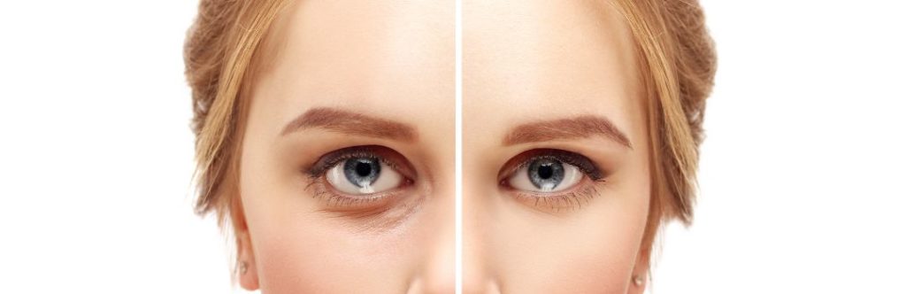 Lower Blepharoplasty Recovery