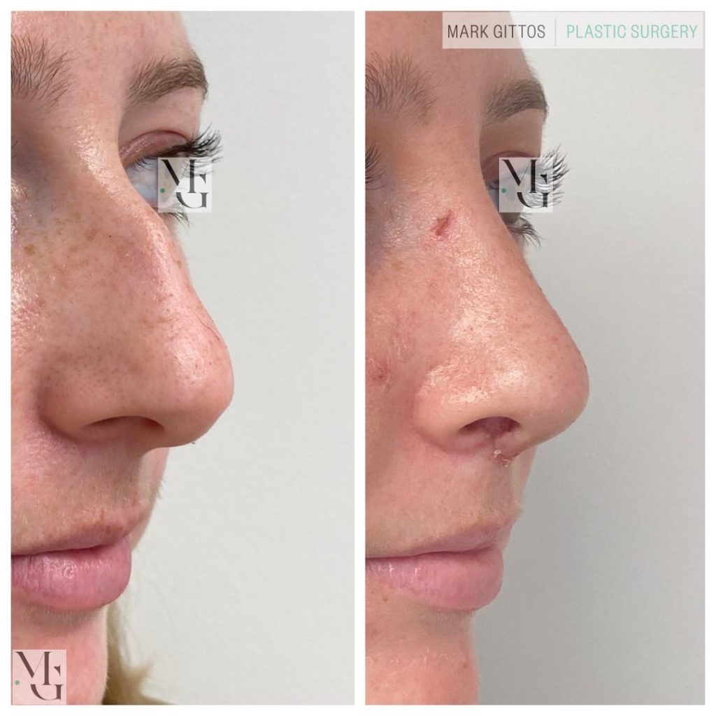 2 Weeks Post operative Septorhinoplasty - Dr Mark Gittos Before and After Photos CdK4nyjrGq3_1