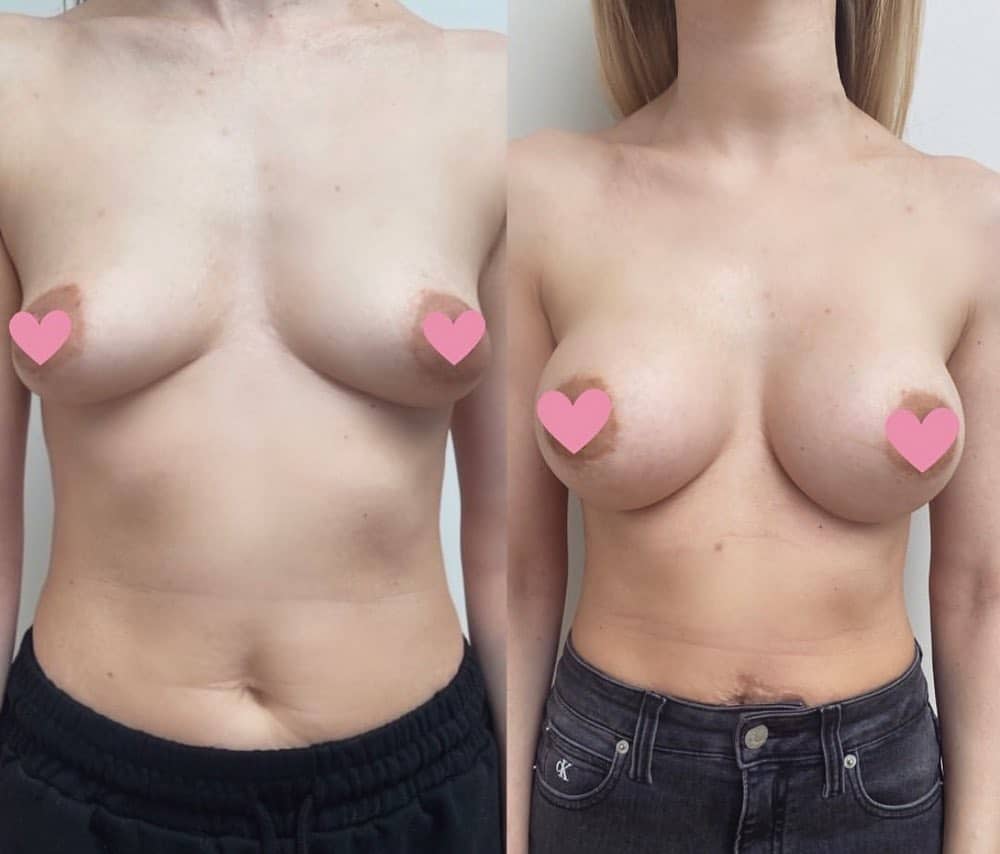 1 year post Bilateral Breast Augmentation - Before and After Photo - Dr Mark Gittos