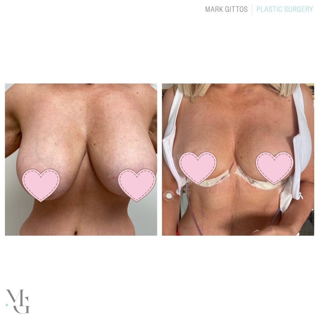 24 hours post op bilateral breast reduction - Before and After Photo - Dr Mark Gittos