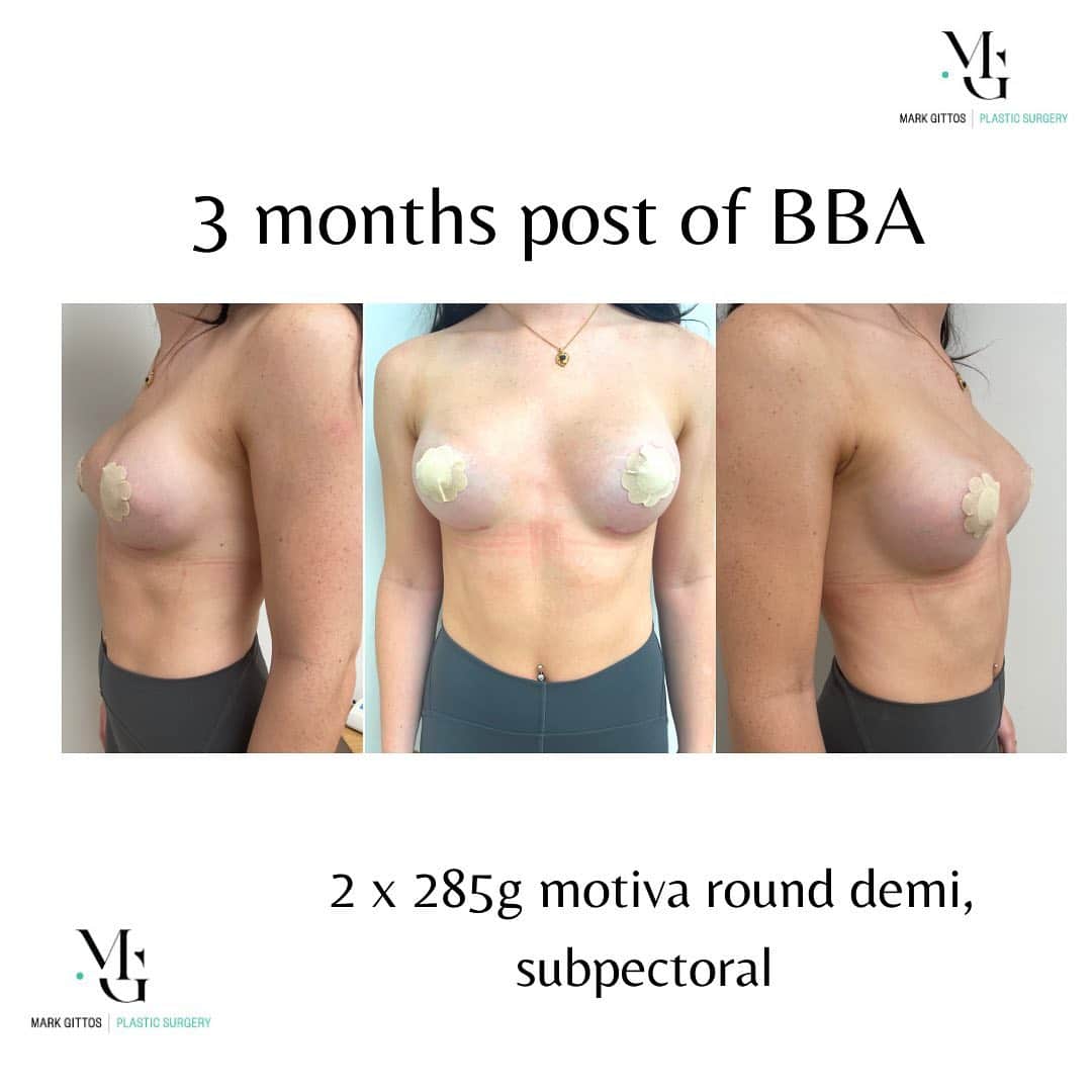 3 Months Breast Augmentation - Before and After Photo - Dr Mark Gittos