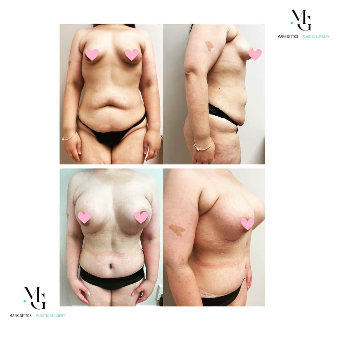 6 weeks post op Bilateral Brachioplasty, Bilateral Breast Augmentation & Umbilical Hernia Repair - Before and After Photo - Dr Mark Gittos