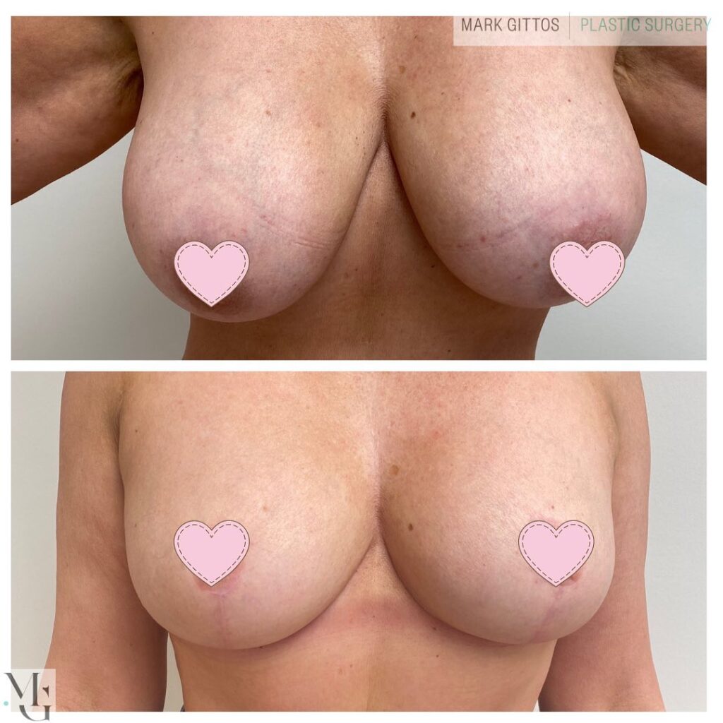 9 months post op bilateral breast reduction - Before and After Photo - Dr Mark Gittos