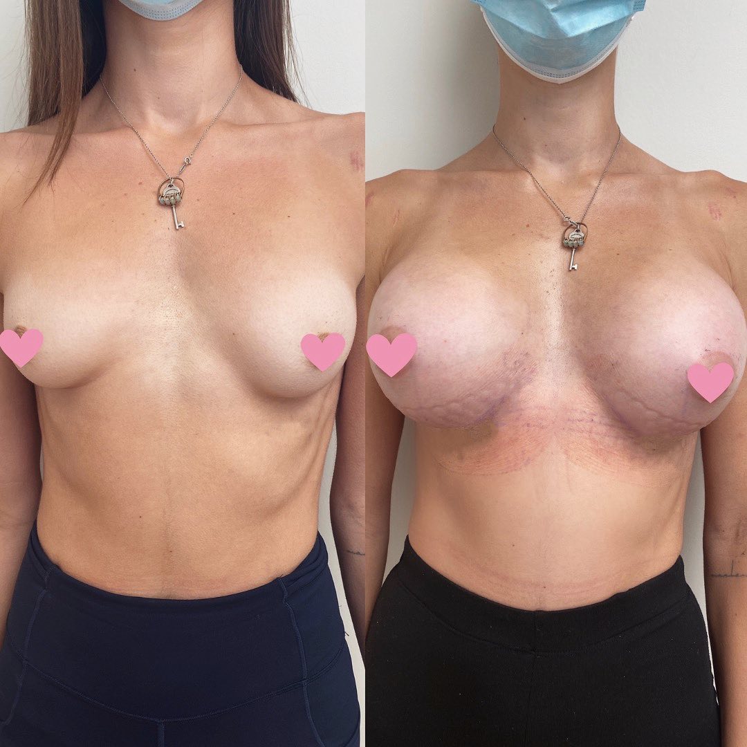 Bilateral Breast Augmentation - Before and After Photo - Dr Mark Gittos 425 cc Motiva Round