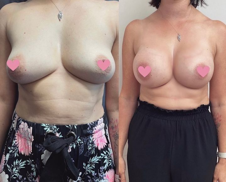 Bilateral Breast Augmentation - Before and After Photo - Dr Mark Gittos