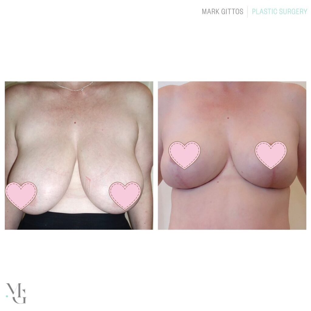 Bilateral Breast Reduction 46 Years Old - Before and After Photo - Dr Mark Gittos