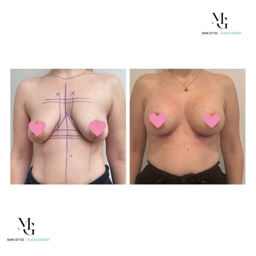 Bilateral sub mammary Breast Augmentation with 425g round - Before and After Photo - Dr Mark Gittos