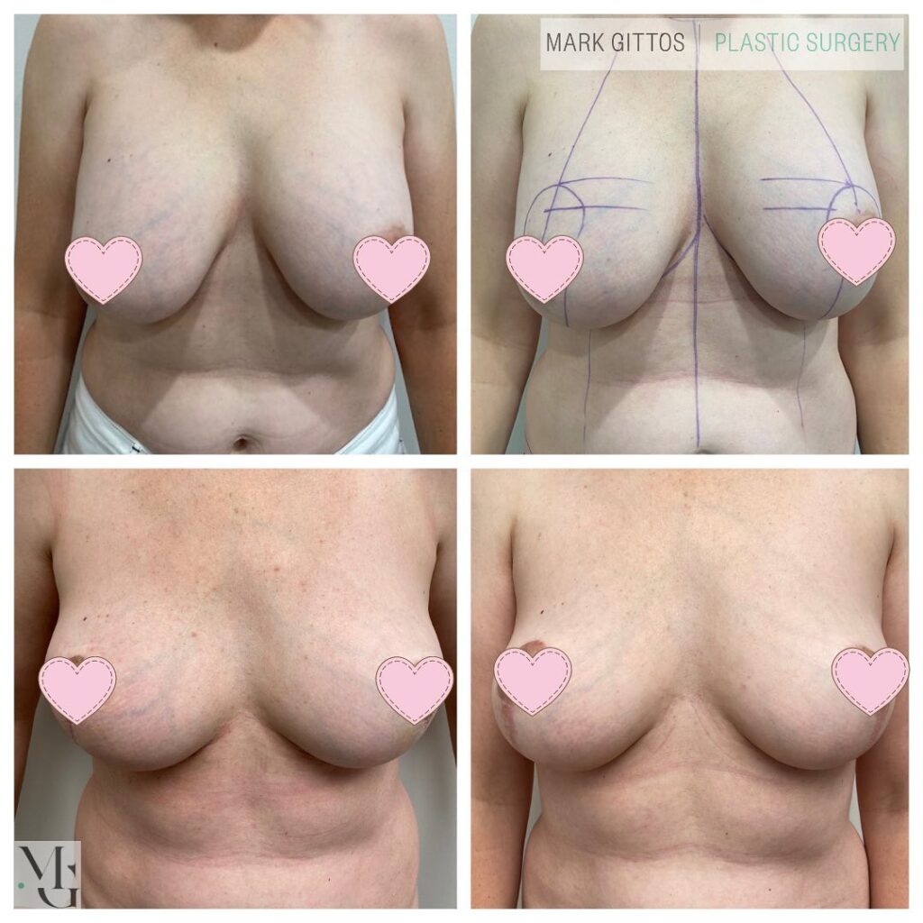 Removed Existing Implants and Mastopexy - Before and After Photo - Dr Mark Gittos