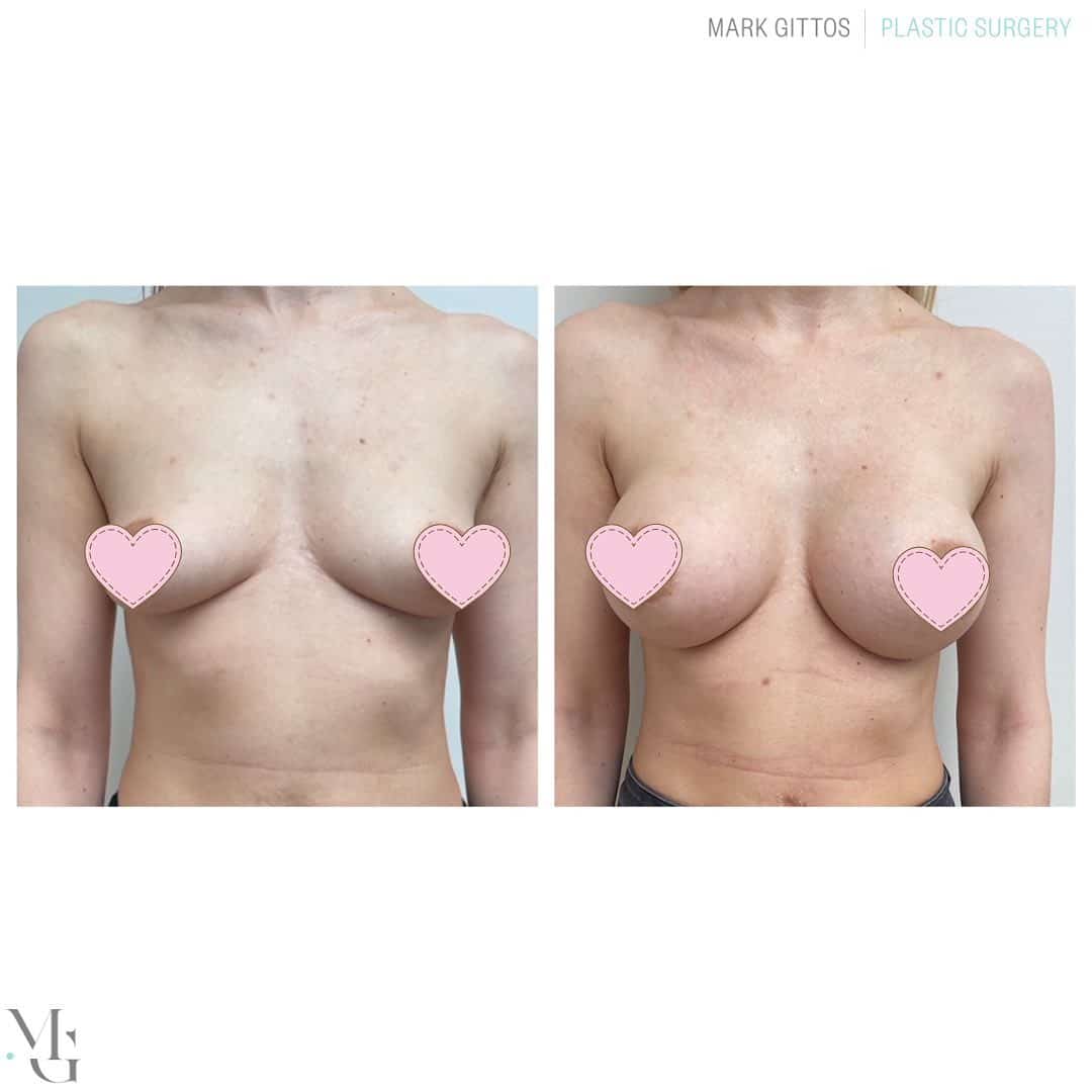 Submammary (over the muscle) Breast Augmentation - Before and After Photo - Dr Mark Gittos