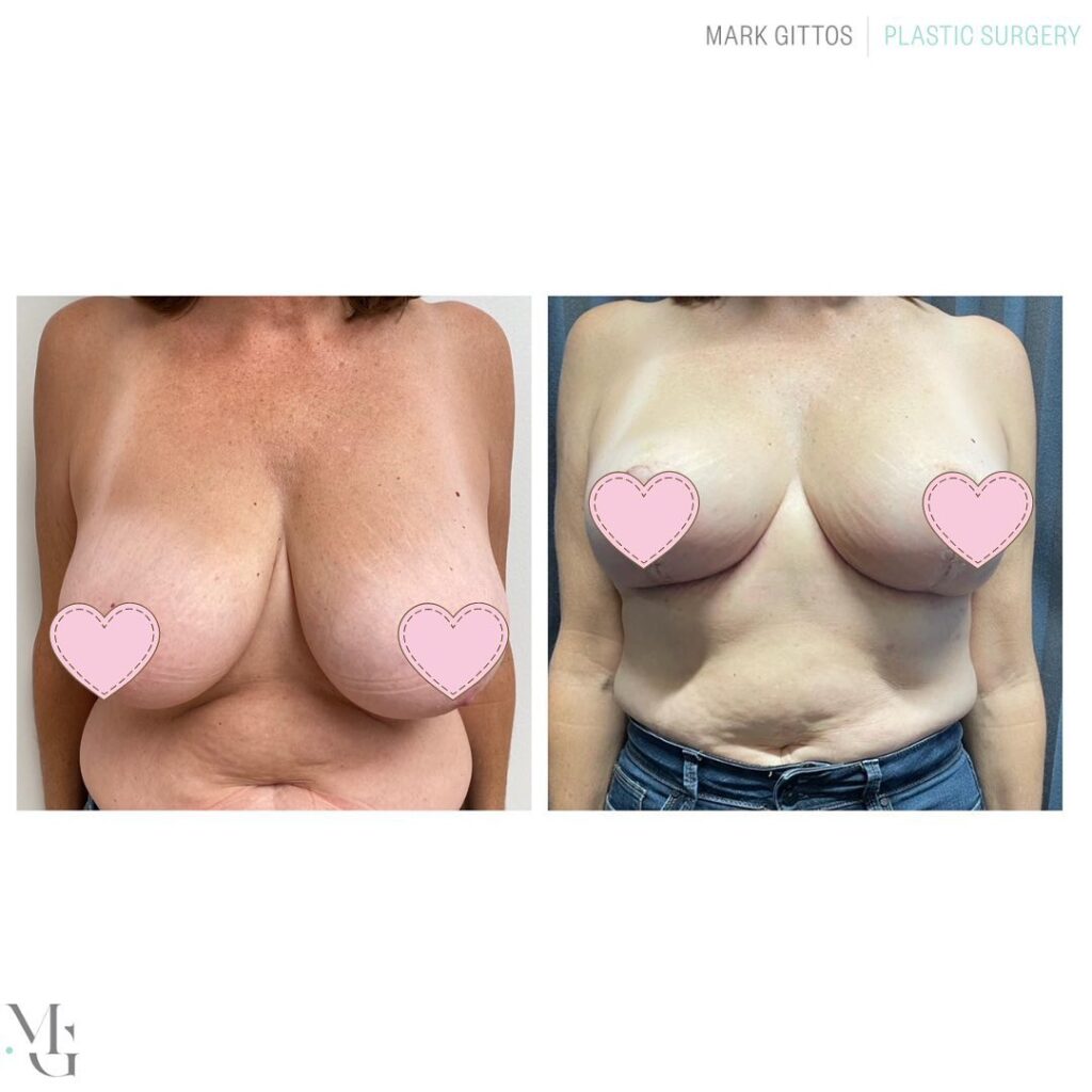 bilateral breast reduction removing 420g - Before and After Photo - Dr Mark Gittos