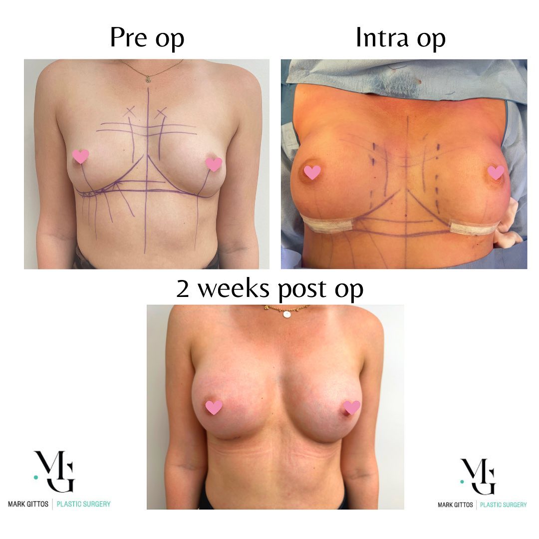 breast augmentation 21 year old patient - Before and After Photo - Dr Mark Gittos