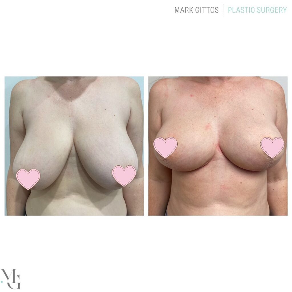 breast reduction - Before and After Photo - Dr Mark Gittos