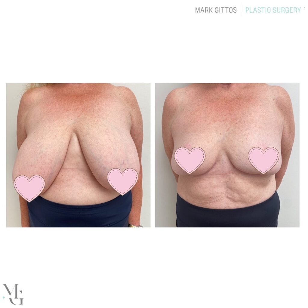 impressive grams removed left side & right breast - Before and After Photo - Dr Mark Gittos