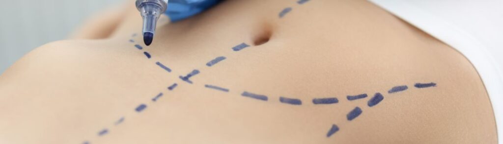 Recovery after tummy tuck surgery